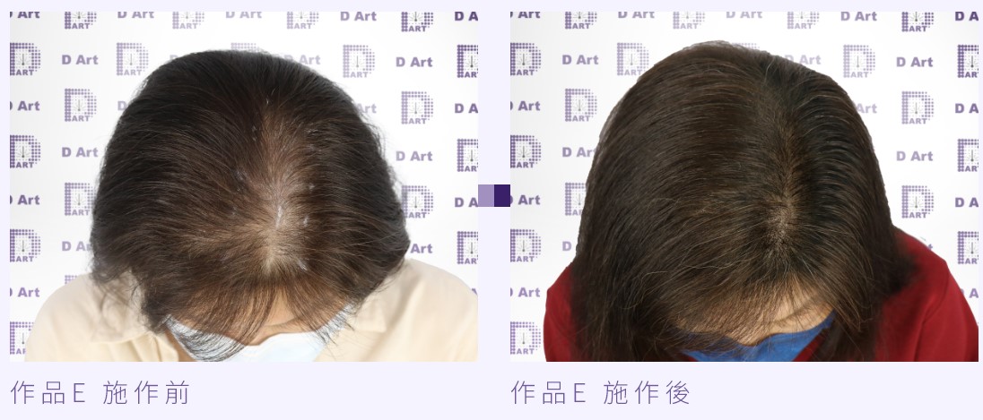 無針擬真繡髮案例E